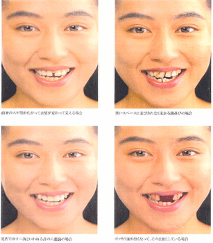 歯並びや歯の形